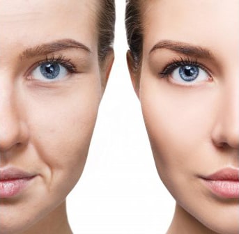 درمان افتادگی پوست صورت و جوانسازی با مزوتراپی پوست